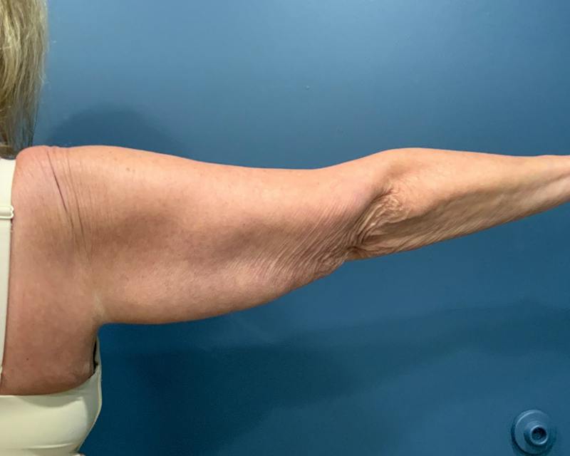 Arm Lift Before & After Gallery - Patient 122623 - Image 1