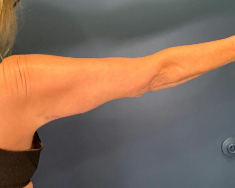 Arm Lift Before & After Gallery - Patient 122623 - Image 2