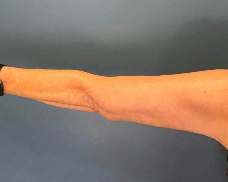 Arm Lift Before & After Gallery - Patient 122623 - Image 4