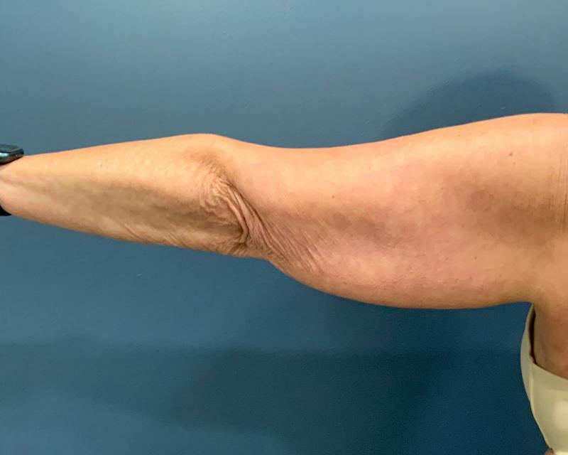 Arm Lift Before & After Gallery - Patient 122623 - Image 3