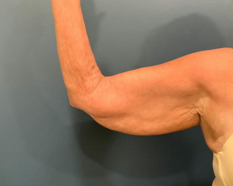 Arm Lift Before & After Gallery - Patient 122623 - Image 5