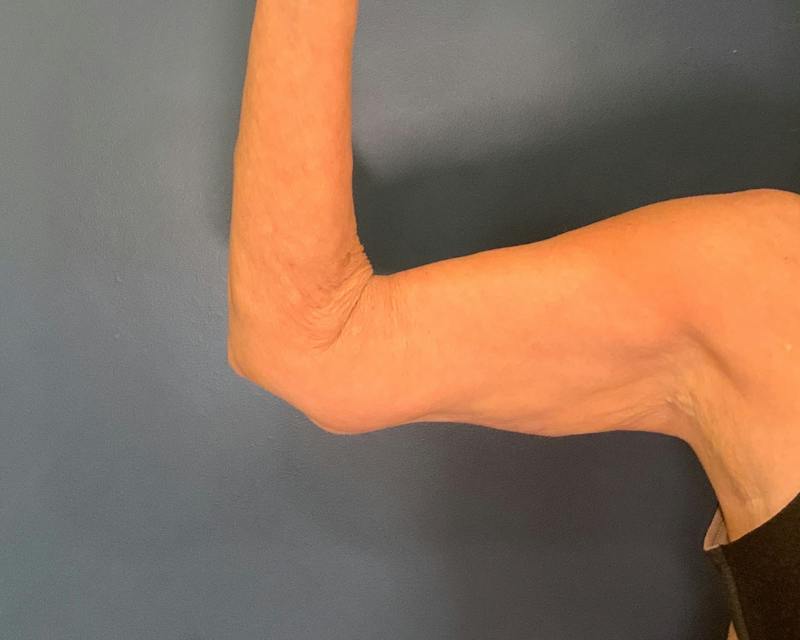 Arm Lift Before & After Gallery - Patient 122623 - Image 6
