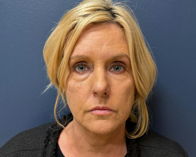 Botox Before & After Gallery - Patient 411642 - Image 1