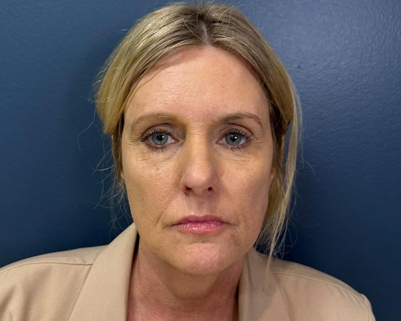 Botox Before & After Gallery - Patient 411642 - Image 2