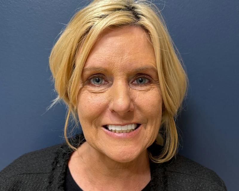 Botox Before & After Gallery - Patient 411642 - Image 3