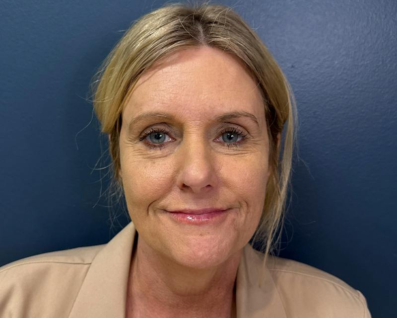 Botox Before & After Gallery - Patient 411642 - Image 4