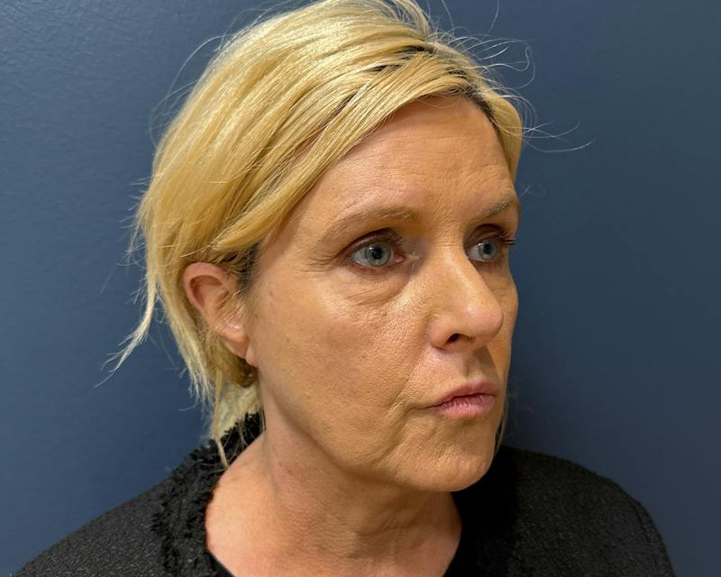 Botox Before & After Gallery - Patient 411642 - Image 6