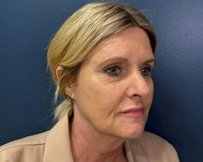 Botox Before & After Gallery - Patient 411642 - Image 5