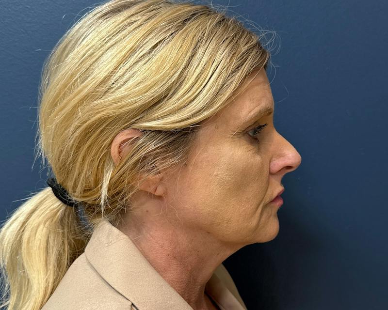 Botox Before & After Gallery - Patient 411642 - Image 7