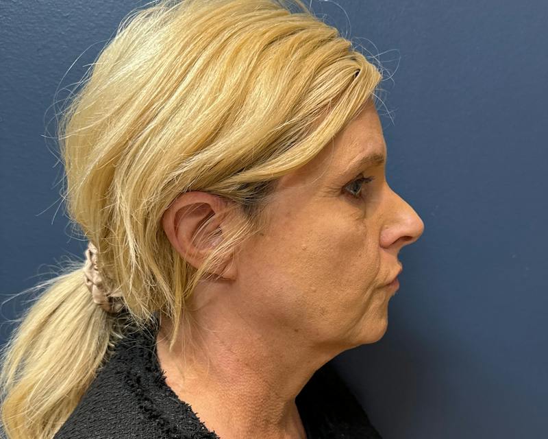 Botox Before & After Gallery - Patient 411642 - Image 8