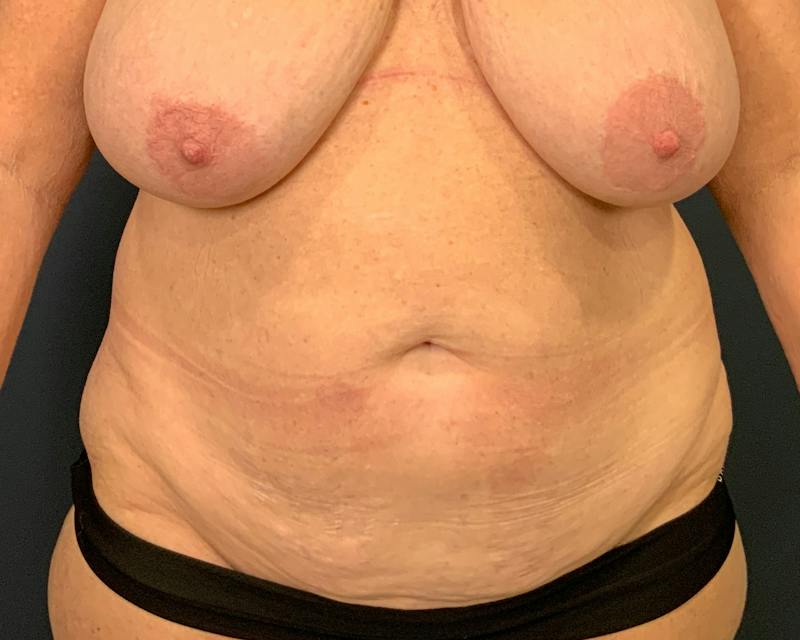Liposuction Before & After Gallery - Patient 989361 - Image 1