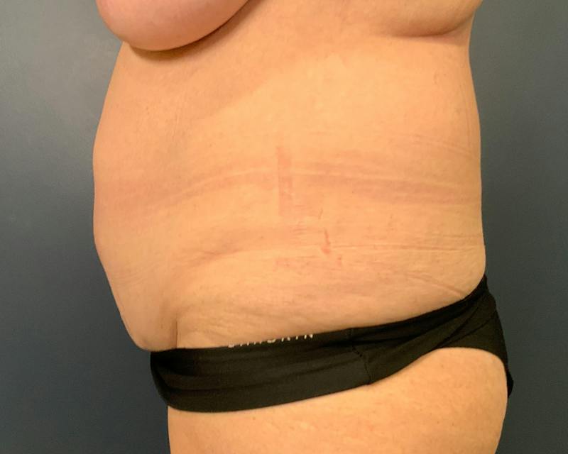 Liposuction Before & After Gallery - Patient 989361 - Image 7