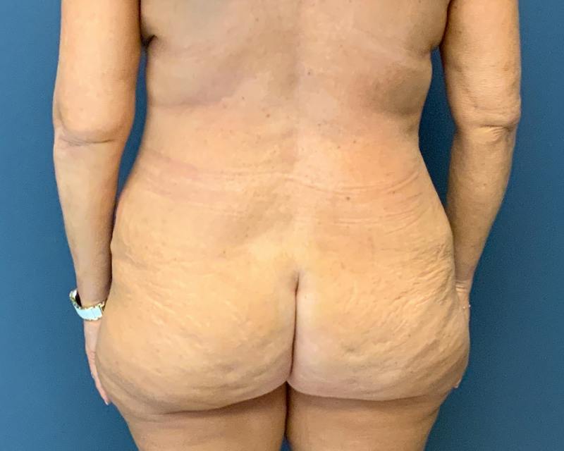 Liposuction Before & After Gallery - Patient 989361 - Image 10