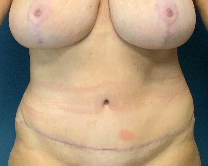 Liposuction Before & After Gallery - Patient 989361 - Image 2