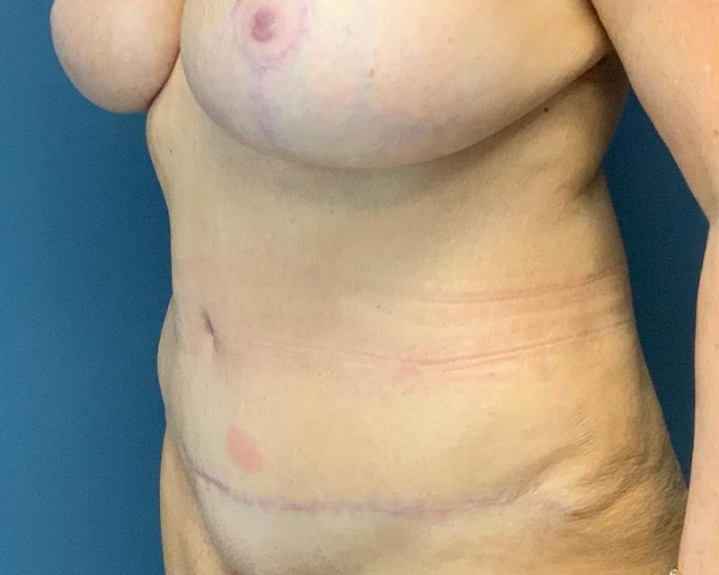 Liposuction Before & After Gallery - Patient 989361 - Image 6