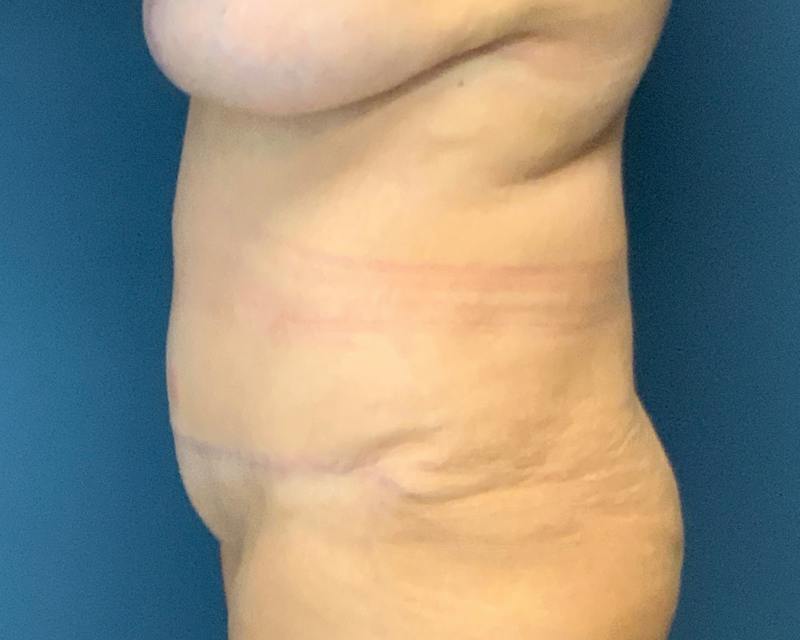 Liposuction Before & After Gallery - Patient 989361 - Image 8