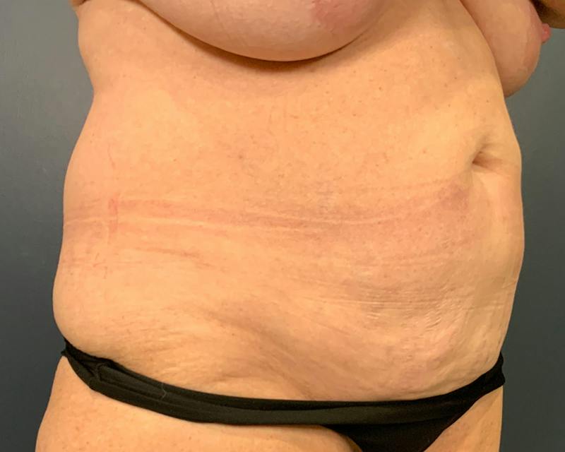 Liposuction Before & After Gallery - Patient 989361 - Image 3