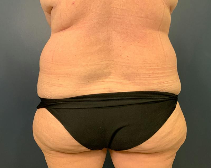 Liposuction Before & After Gallery - Patient 989361 - Image 9