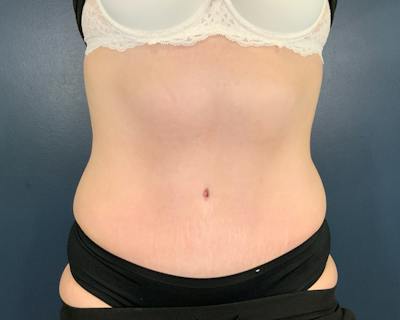 Tummy Tuck Before & After Gallery - Patient 266595 - Image 2