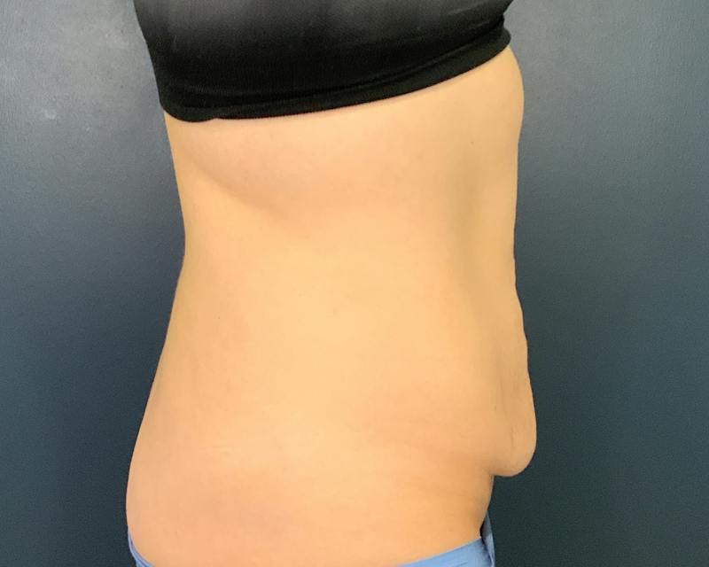 Tummy Tuck Before & After Gallery - Patient 266595 - Image 3