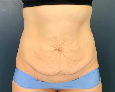 Tummy Tuck Before & After Gallery - Patient 266595 - Image 1