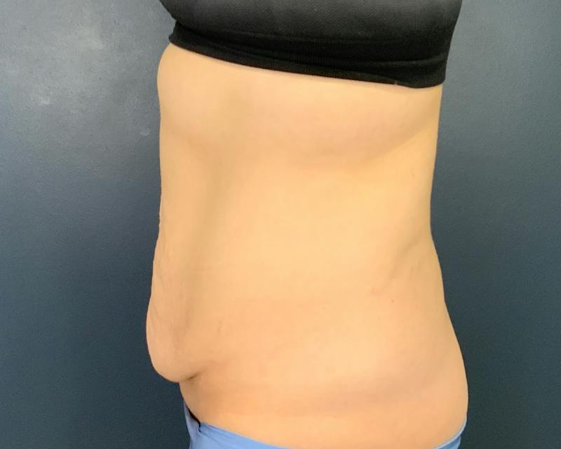 Tummy Tuck Before & After Gallery - Patient 266595 - Image 7