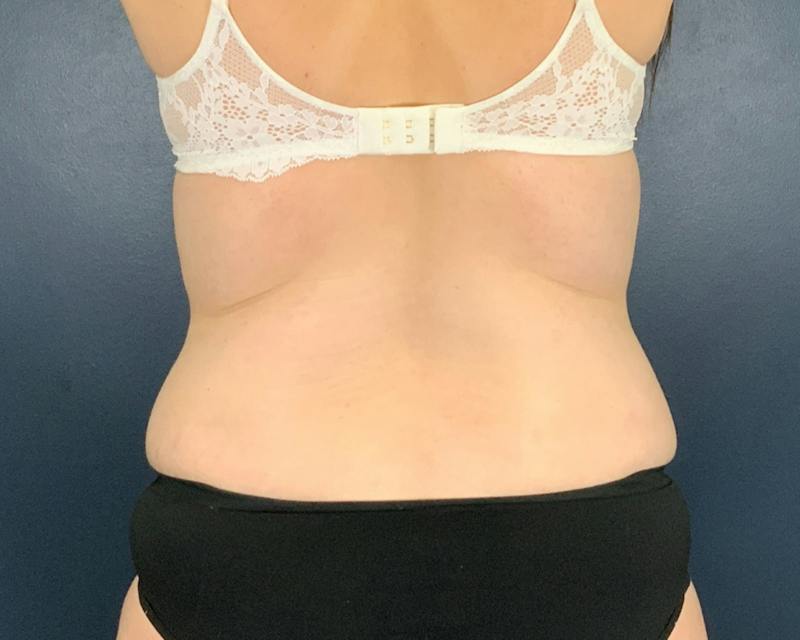 Tummy Tuck Before & After Gallery - Patient 266595 - Image 6
