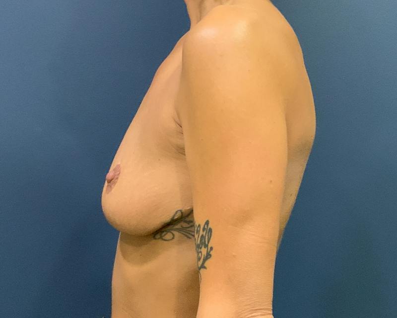 Breast Lift with Augmentation Before & After Gallery - Patient 516551 - Image 9