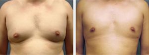 gynecomastia surgery results