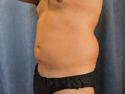 Male Liposuction Before & After Gallery - Patient 369197 - Image 1