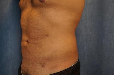 Male Liposuction Before & After Gallery - Patient 369197 - Image 2