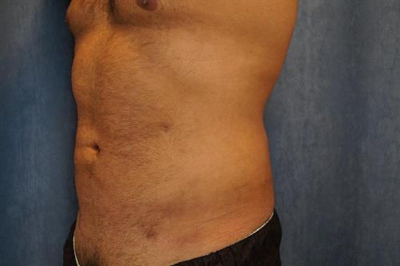 Male Liposuction Before & After Gallery - Patient 369197 - Image 2