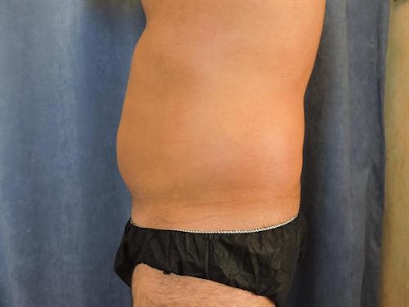 Male Liposuction Before & After Gallery - Patient 369197 - Image 3