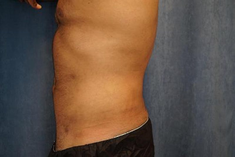 Male Liposuction Before & After Gallery - Patient 369197 - Image 4