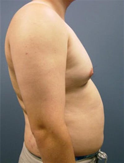 Male Liposuction Before & After Gallery - Patient 219218 - Image 1