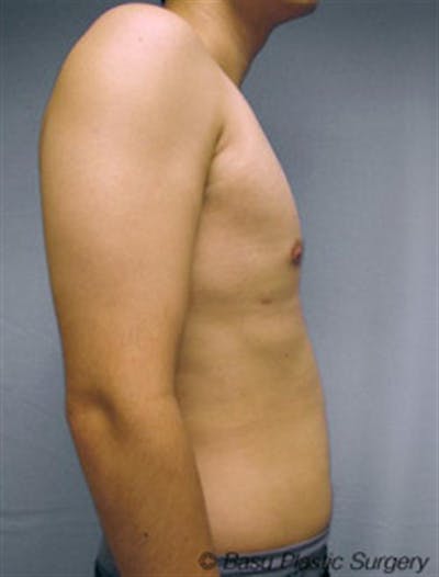 Male Liposuction Before & After Gallery - Patient 219218 - Image 2