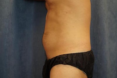 Male Liposuction Before & After Gallery - Patient 200314 - Image 1