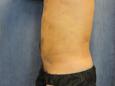 Male Liposuction Before & After Gallery - Patient 200314 - Image 2