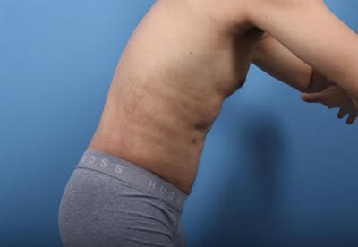 Male Liposuction Before & After Gallery - Patient 412165 - Image 2