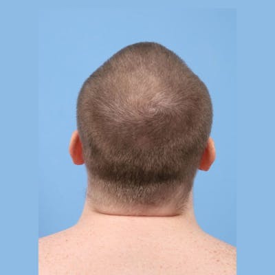 Neograft Before & After Gallery - Patient 338281 - Image 1