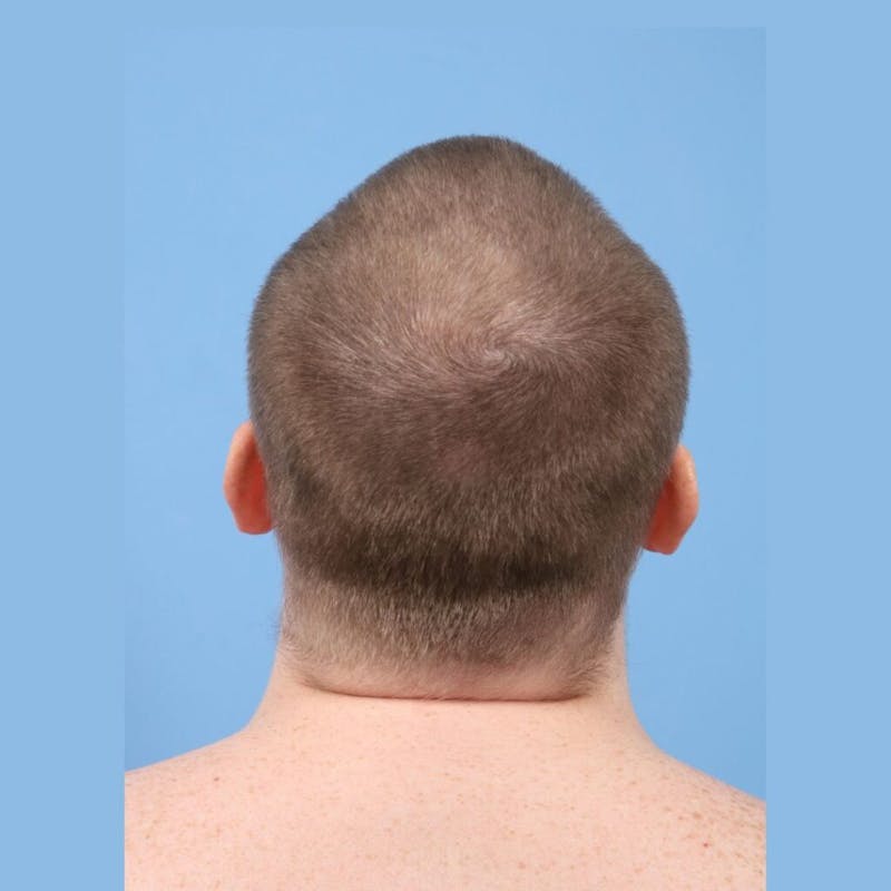 Neograft Before & After Gallery - Patient 338281 - Image 1