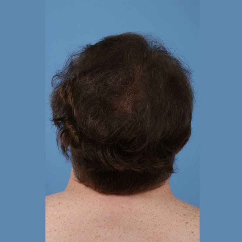 Neograft Before & After Gallery - Patient 338281 - Image 2