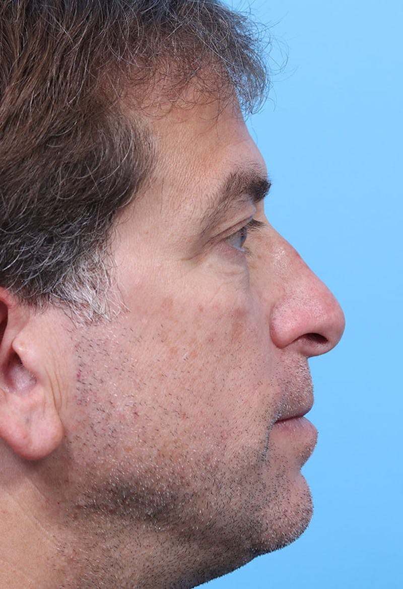 Male Rhinoplasty Before & After Gallery - Patient 234389 - Image 1