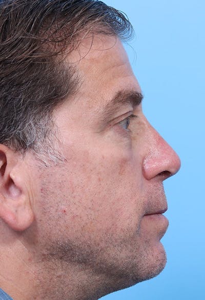Male Rhinoplasty Before & After Gallery - Patient 234389 - Image 2