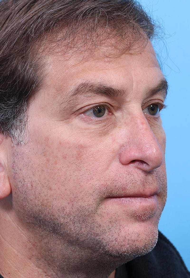 Male Rhinoplasty Before & After Gallery - Patient 234389 - Image 3