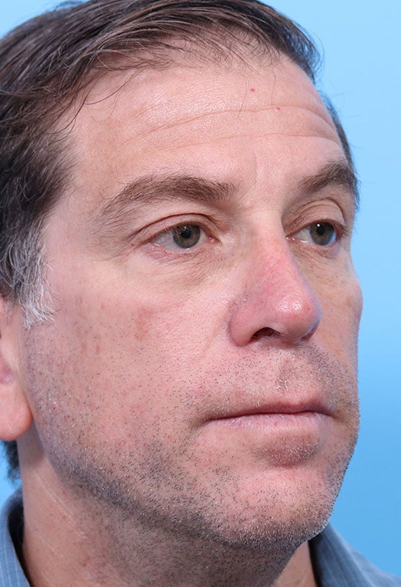 Male Rhinoplasty Before & After Gallery - Patient 234389 - Image 4
