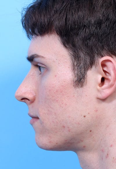 Male Rhinoplasty Before & After Gallery - Patient 137302 - Image 1