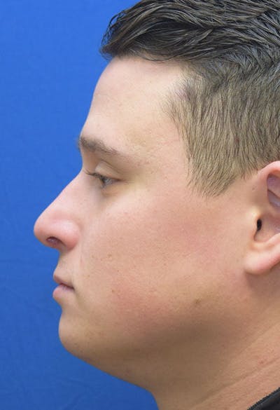 Male Rhinoplasty Before & After Gallery - Patient 112204 - Image 2