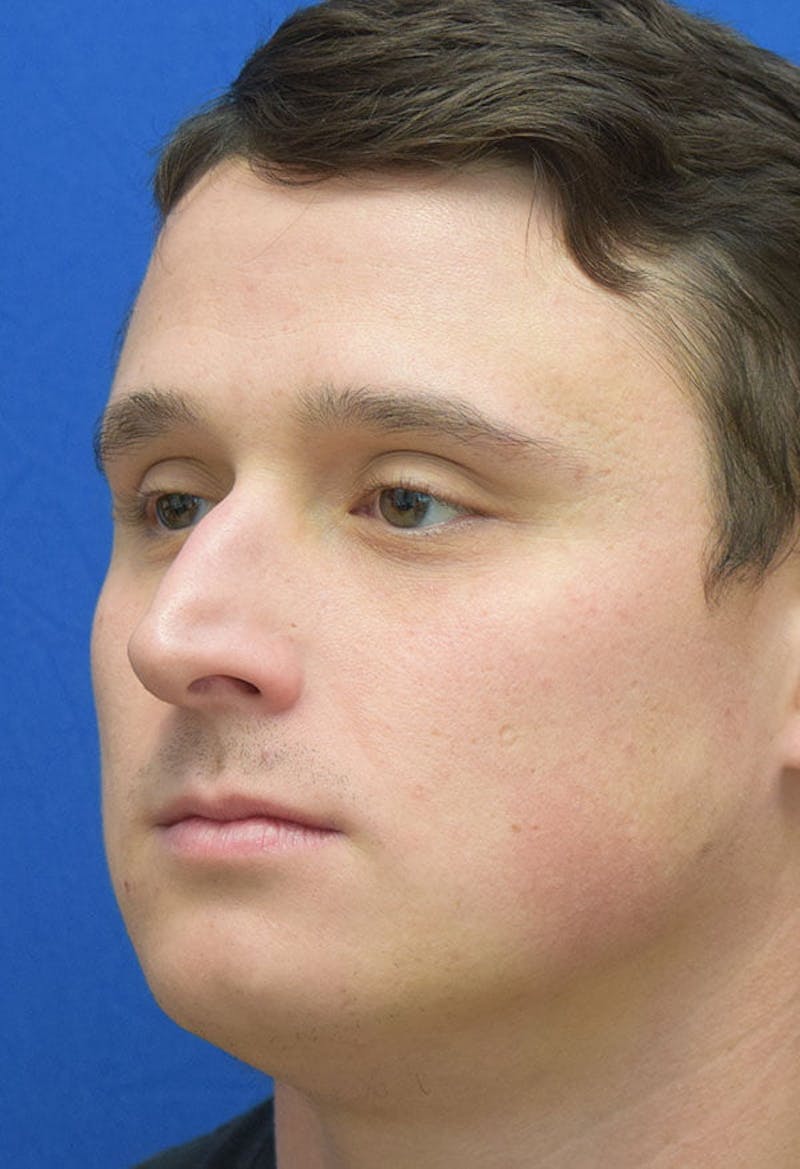 Male Rhinoplasty Before & After Gallery - Patient 112204 - Image 3