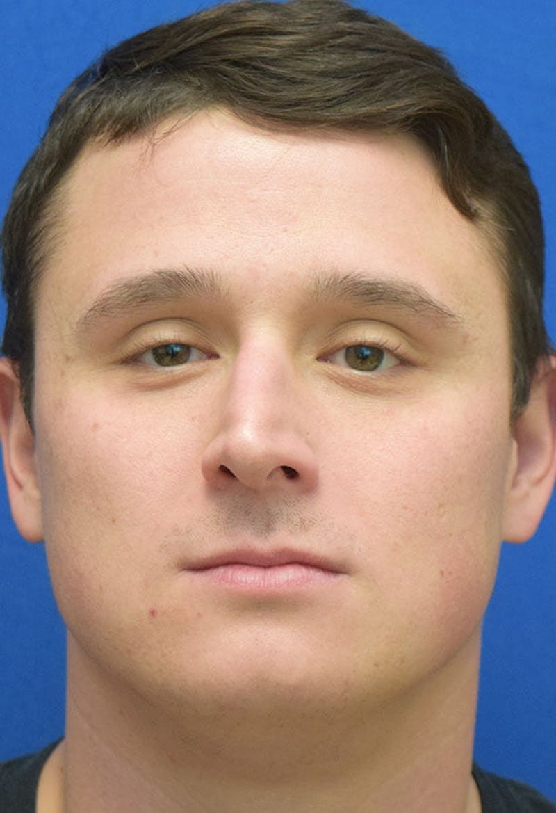 Male Rhinoplasty Before & After Gallery - Patient 112204 - Image 5